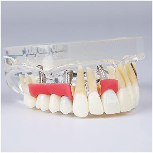 Modelo de Restauração da Overdentura Superior KH66ZKY - Modelo de dentes de implante dentário - com pilar, prego de implante,